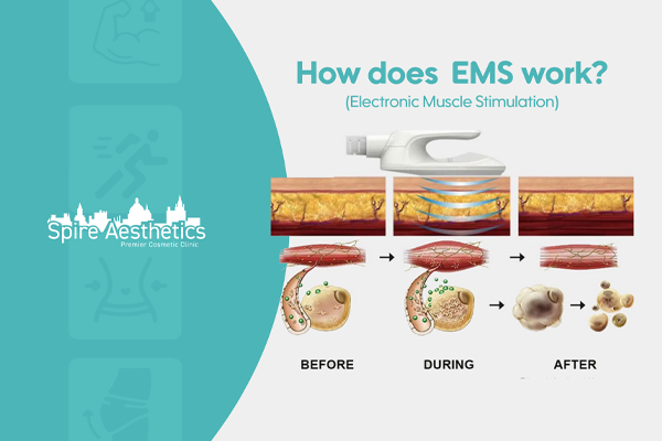EMS treatment for post pregnancy weight loss treatment Skelmersdale
