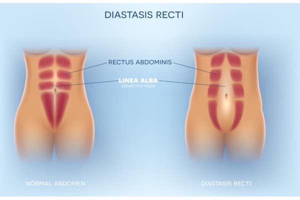 What Non-Surgical Options Are Available for Diastasis Recti Skelmersdale?