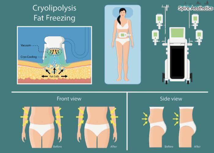 Image of diet and fat freezing combined for best results for Spire Aesthetics Skelmersdale