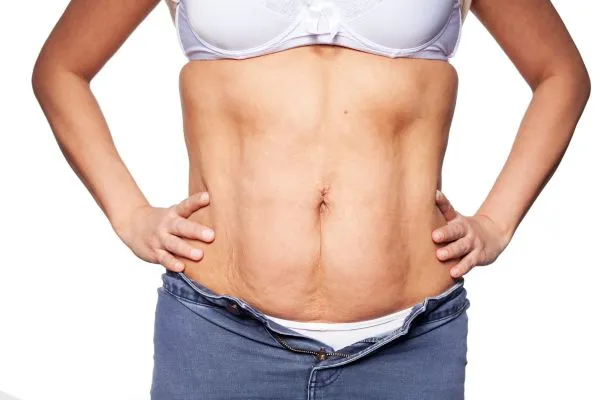 sagging skin on woman's stomach after weight loss injections Skelmersdale