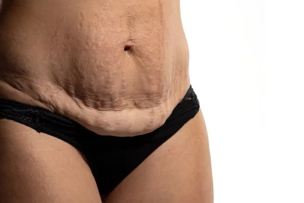 Image of womans stomach after weight loss injections Skelmersdale showing saggy skin