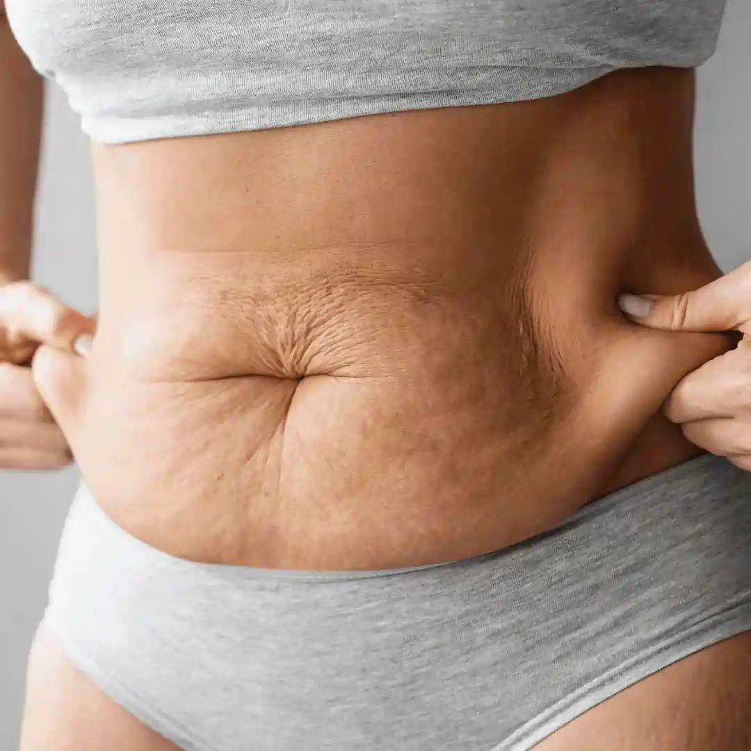 Is It Normal to Have Loose Skin After Pregnancy Skelmersdale?